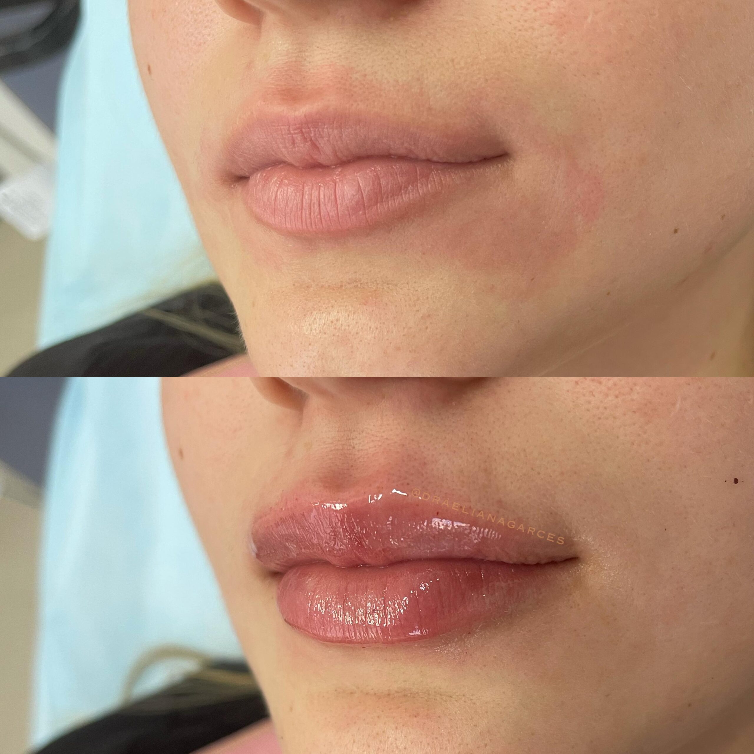 Aumento de Labios - Antes y Después