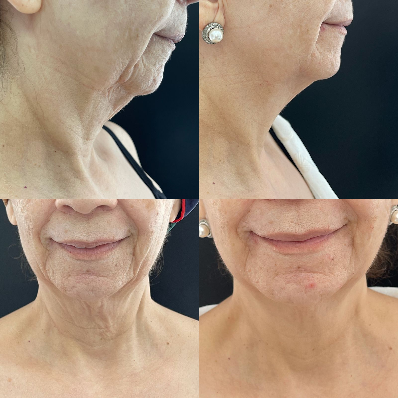 Lifting de Cuello - Antes y Después