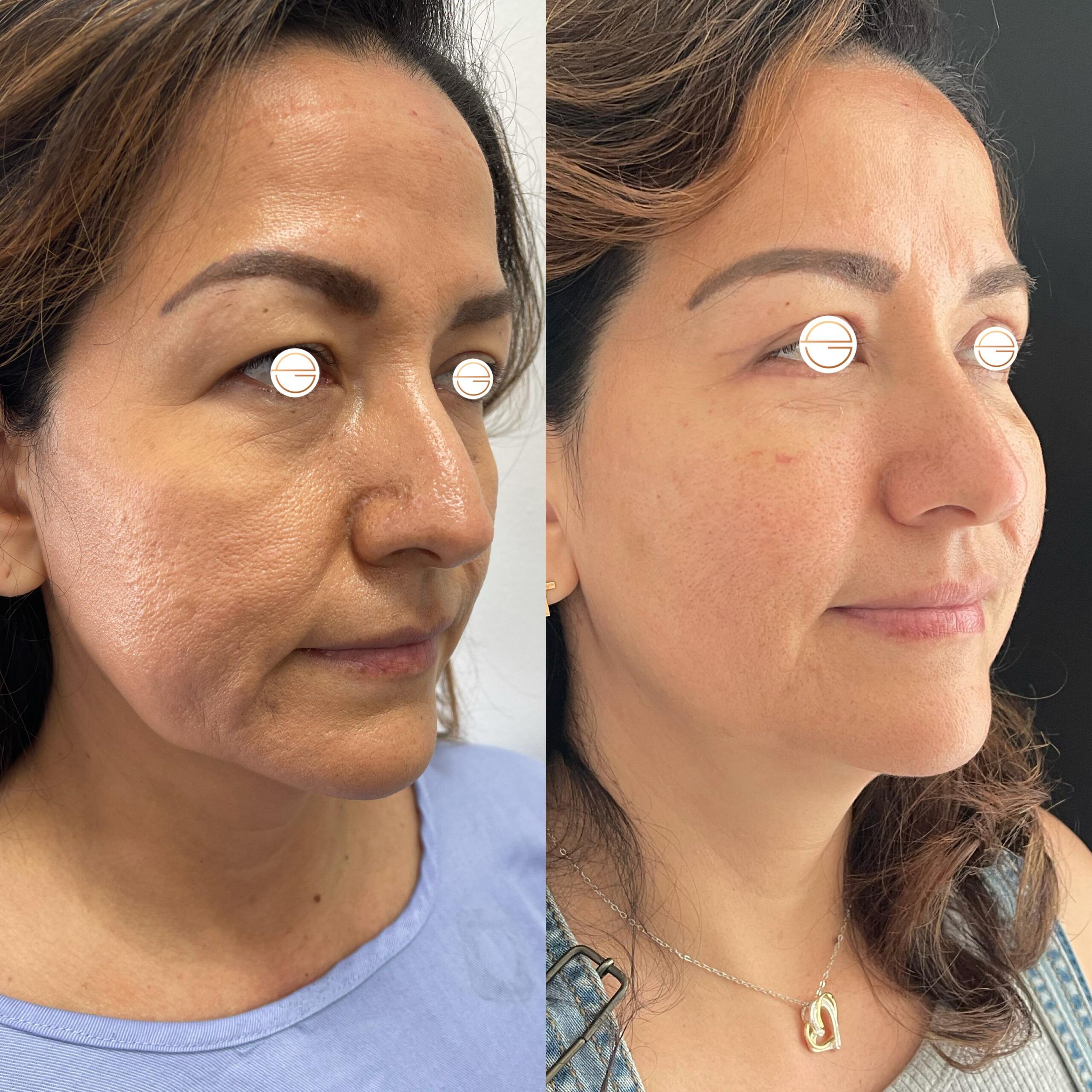Lifting Facial - Antes y Después