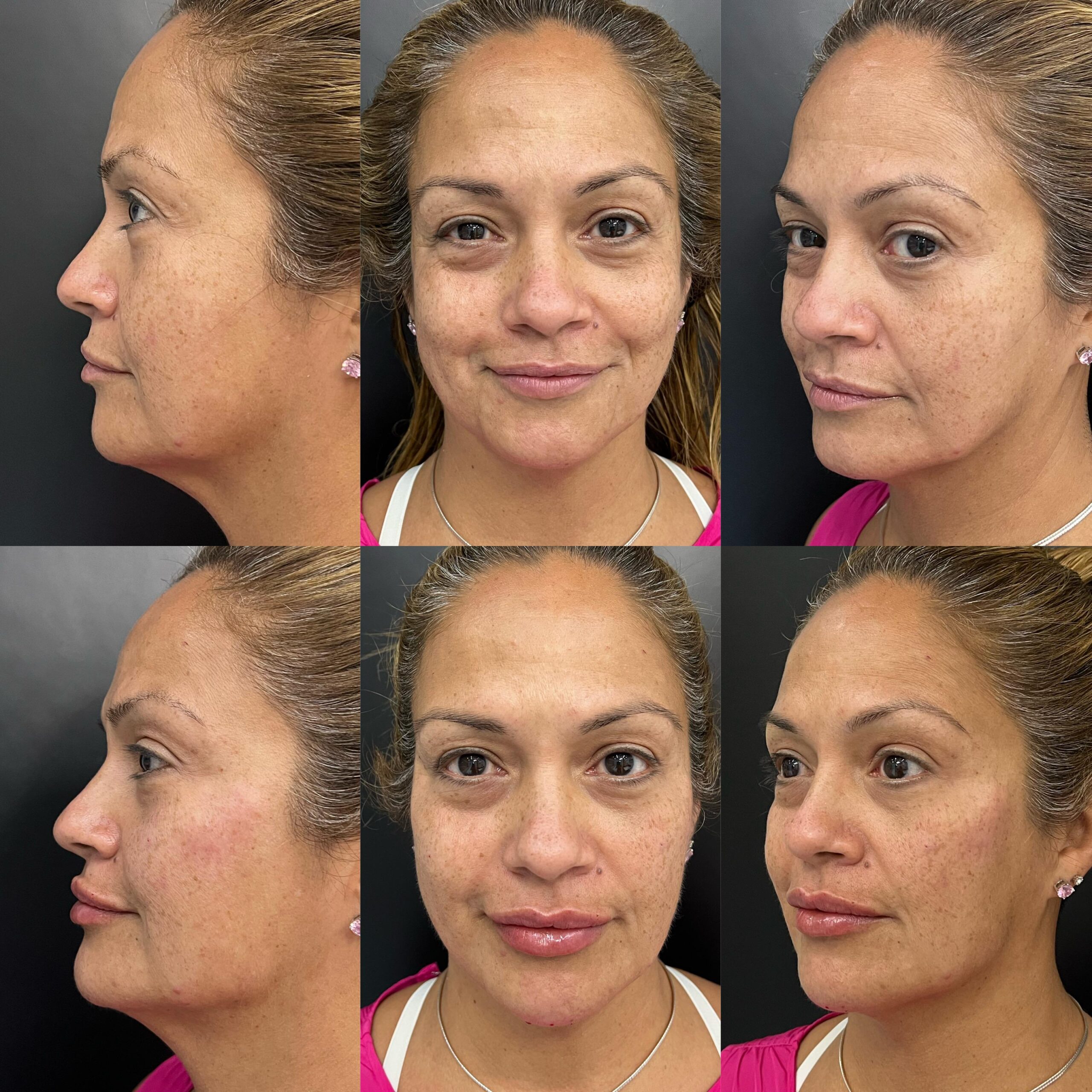 Rejuvenecimiento Facial - Antes y Después