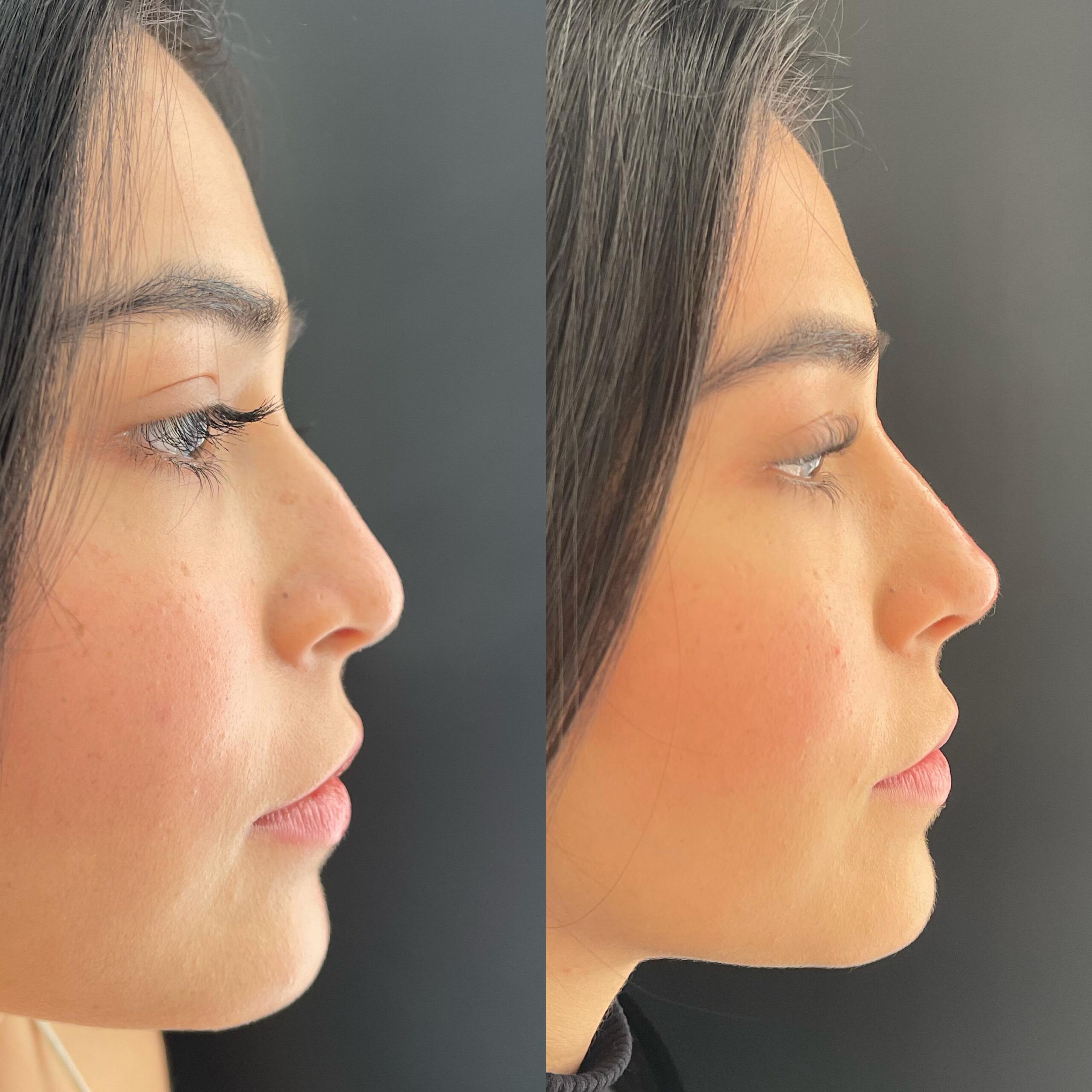 Rinoplastia Ultrasónica - Antes y Después