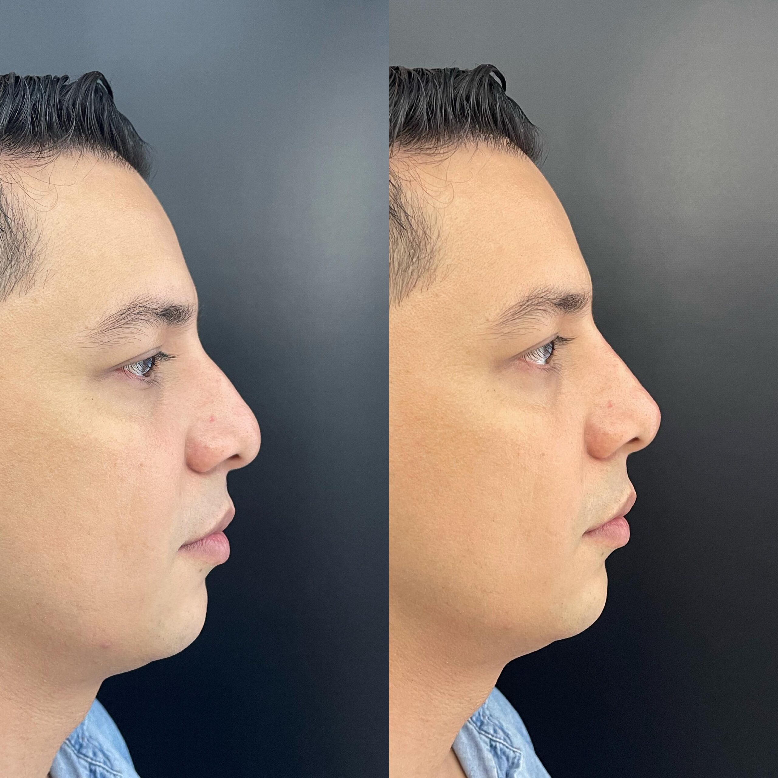 Rinoplastia Masculina - Antes y Después